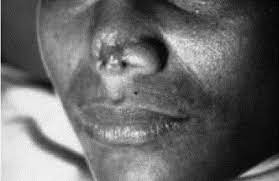 Septuagenarian, Son Arraigned For Biting Off Woman’s Nose In Ogun